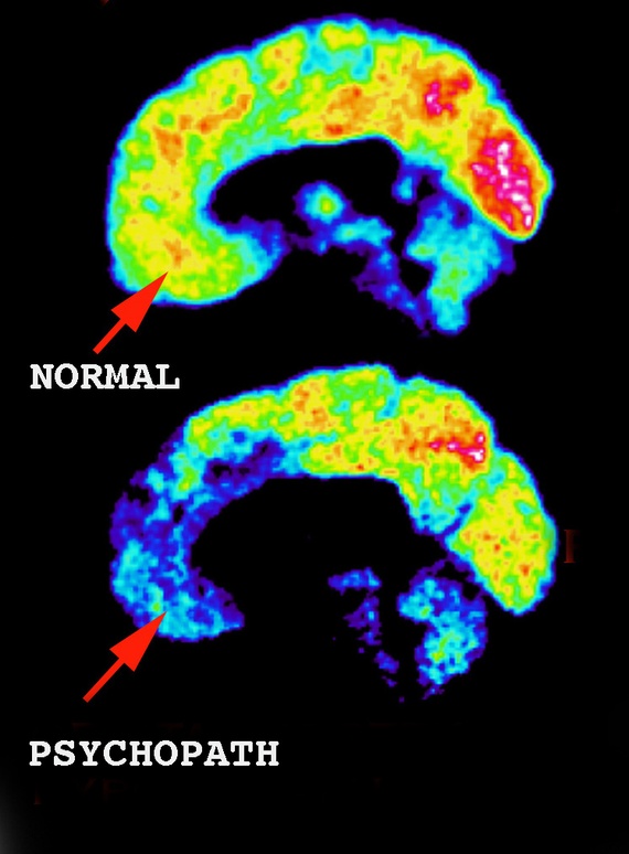 Psykopatens hjärna i jämförelse med normalhjärnan